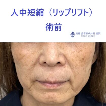 TT ﾘｯﾌﾟﾘﾌﾄ術前