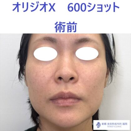 AK ｵﾘｼﾞｵ術前