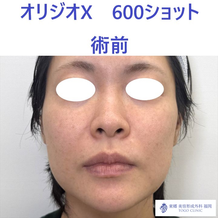 AK ｵﾘｼﾞｵ術前