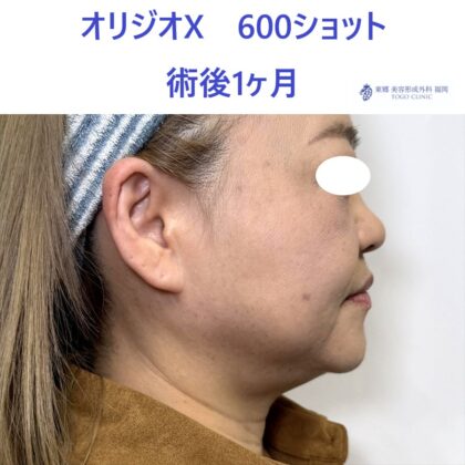 YS オリジオ術後 (3)