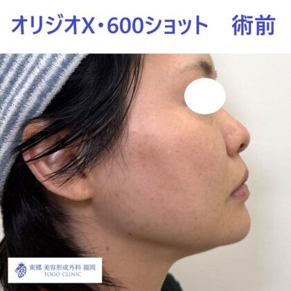 AK　オリジオ　術前