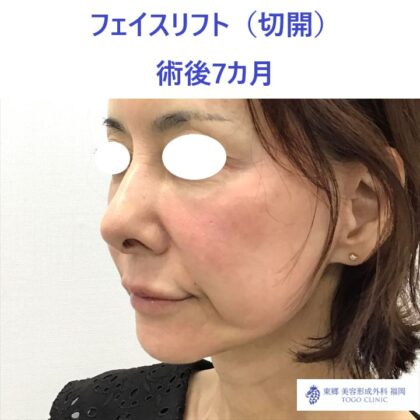 AU　フェイスリフト術後 (3)