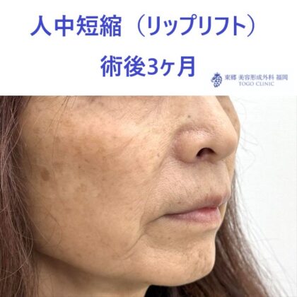 TT　ﾘｯﾌﾟﾘﾌﾄ術後 (2)