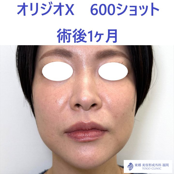 AK　オリジオ術後