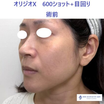 ES　ｵﾘｼﾞｵ術前_R