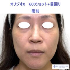 ES ｵﾘｼﾞｵ術前_R