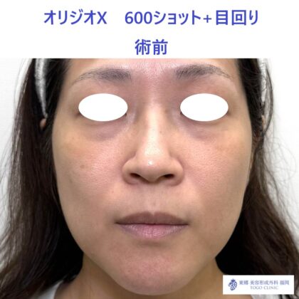 ES ｵﾘｼﾞｵ術前_R