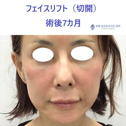 AU　フェイスリフト術後