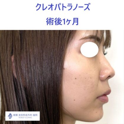 MS　KPノーズ術後 (3)