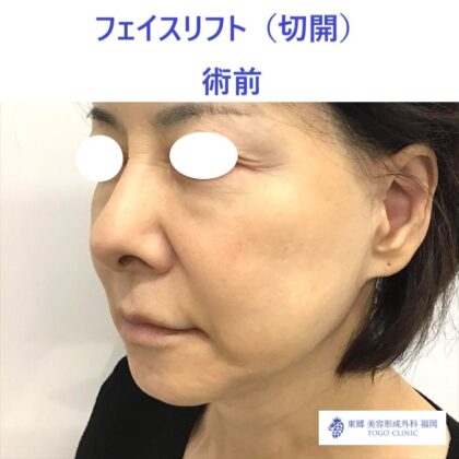 AU　フェイスリフト術前 (3)