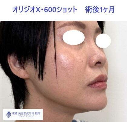 AK　オリジオ術後 (2)