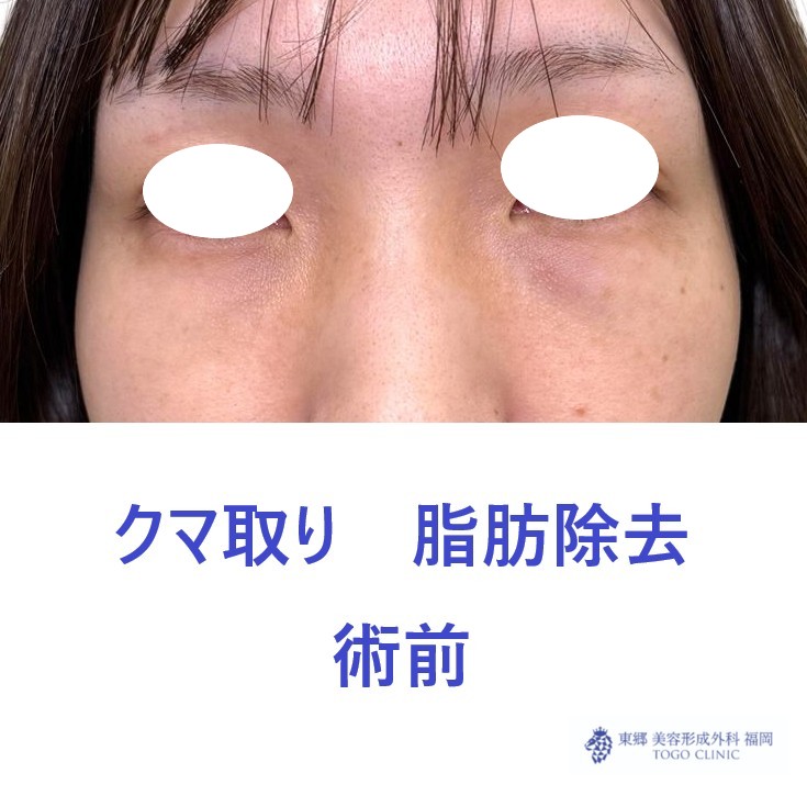 HN　経結膜術前