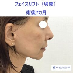 AU　フェイスリフト術後 (2)