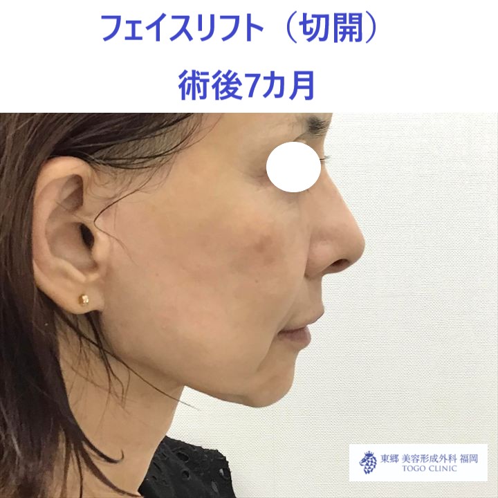 AU　フェイスリフト術後 (2)