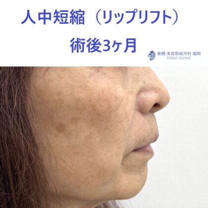 TT　ﾘｯﾌﾟﾘﾌﾄ術後 (3)