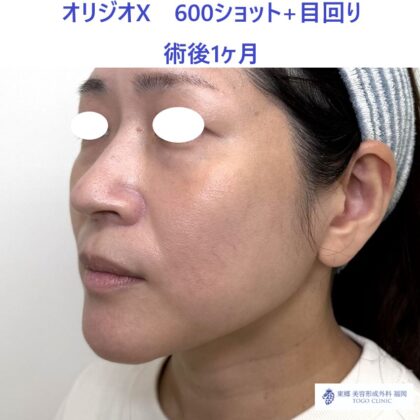 ES　オリジオ術後 (2)_R