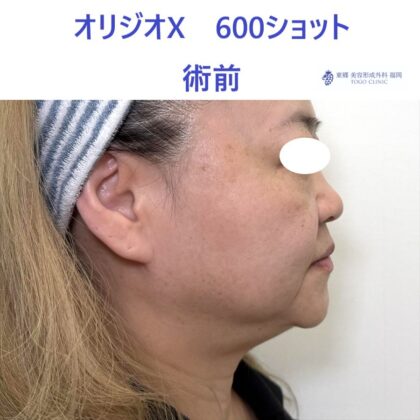 YS オリジオ術前 (2)