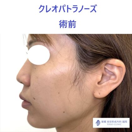 MS　KPノーズ術前 (2)