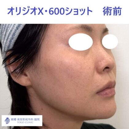 AK　オリジオ術前