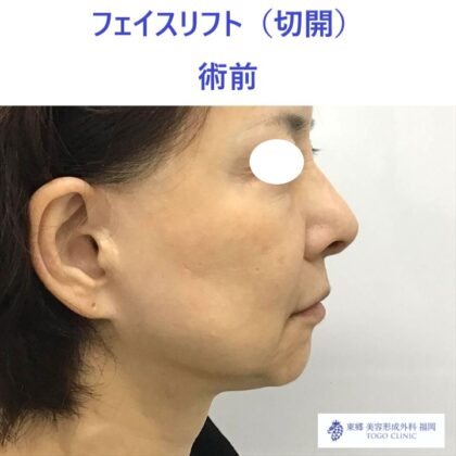 AU　フェイスリフト術前 (2)