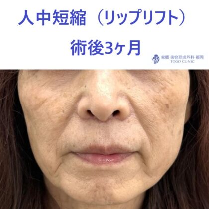 TT　ﾘｯﾌﾟﾘﾌﾄ術後