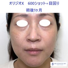 ES　オリジオ術後_R