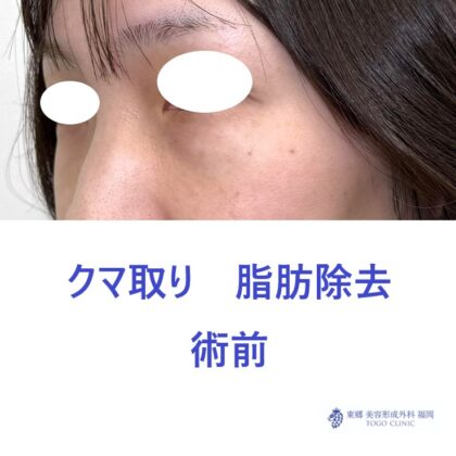 HN　経結膜術前 (2)