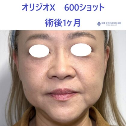 YS オリジオ術後