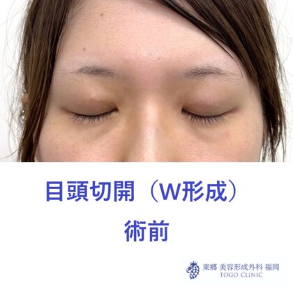 MK　目頭　術前 (2)_R