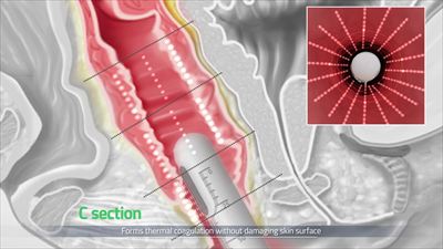 膣ハイフ（ウルトラヴェラ）の照射イメージ