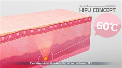 膣ハイフ（ウルトラヴェラ）の作用機序