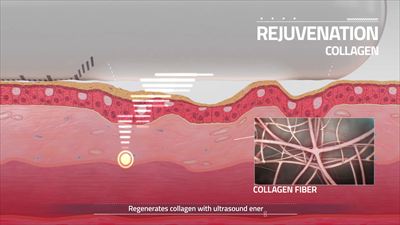 膣ハイフ（ウルトラヴェラ）のコラーゲン合成