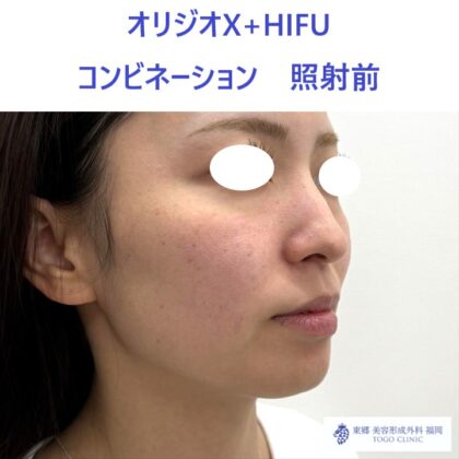 MY　ｵﾘｼﾞｵ術前 (2)