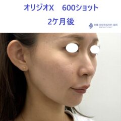 AO オリジオ術後 (3)
