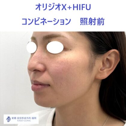 MY　ｵﾘｼﾞｵ術前