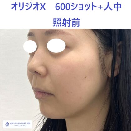 SK　オリジオ術前　リップ