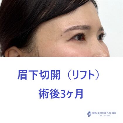 IM　眉下術後 (3)