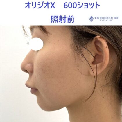 AO　ｵﾘｼﾞｵ術前 (2)