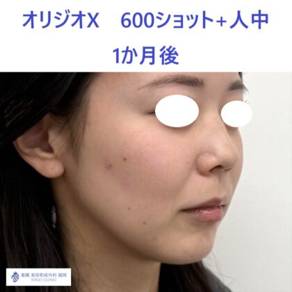 SK　オリジオ術後 (2)