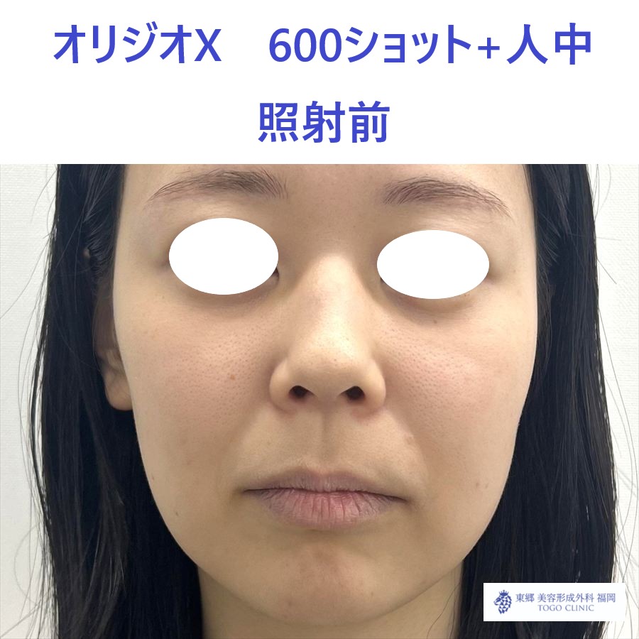 SK ｵﾘｼﾞｵ術前 (1)