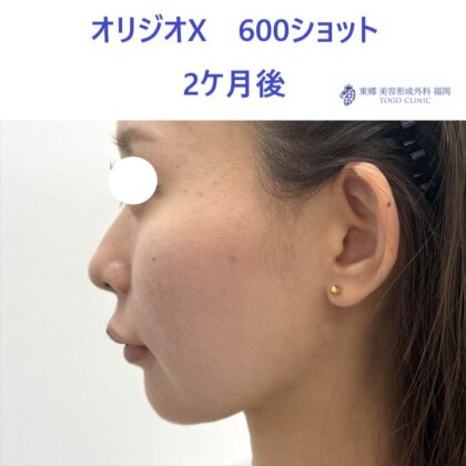 AO　ｵﾘｼﾞｵ術後 (2)2