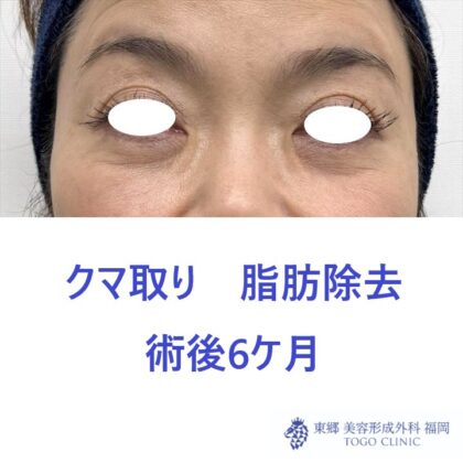 MK　経結膜　術後