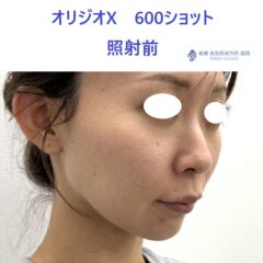 AO オリジオ術前 (3)