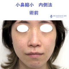 HM 小鼻縮小 術前