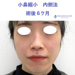 HM 小鼻縮小 術後