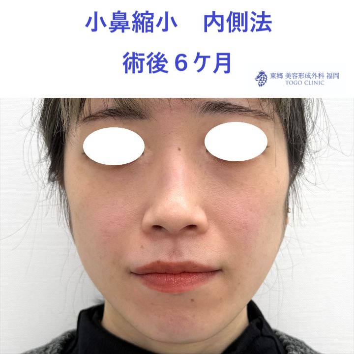 HM　小鼻縮小　術後