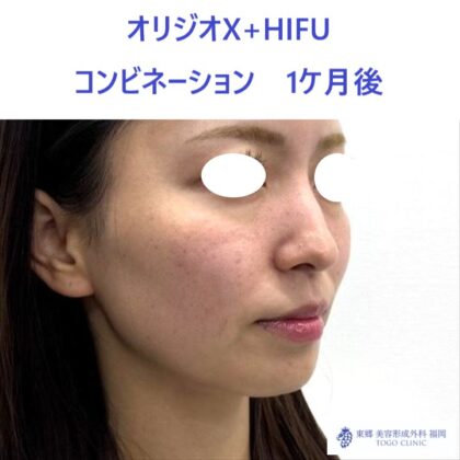 MY　オリジオ術後 (2)