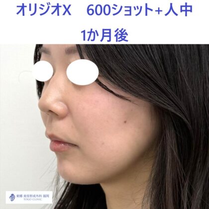 SK　オリジオ術後 リップ