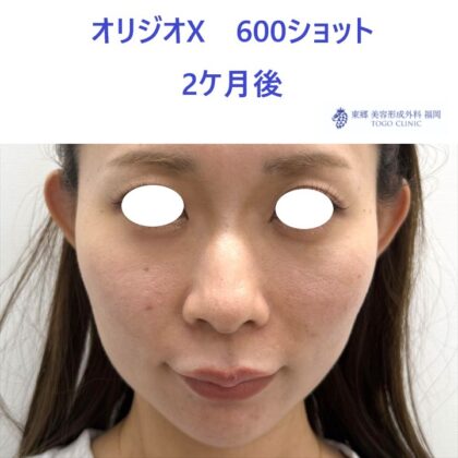 AO　ｵﾘｼﾞｵ術後