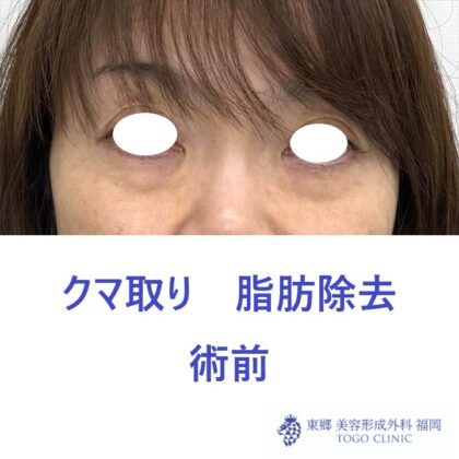 MK　経結膜　術前